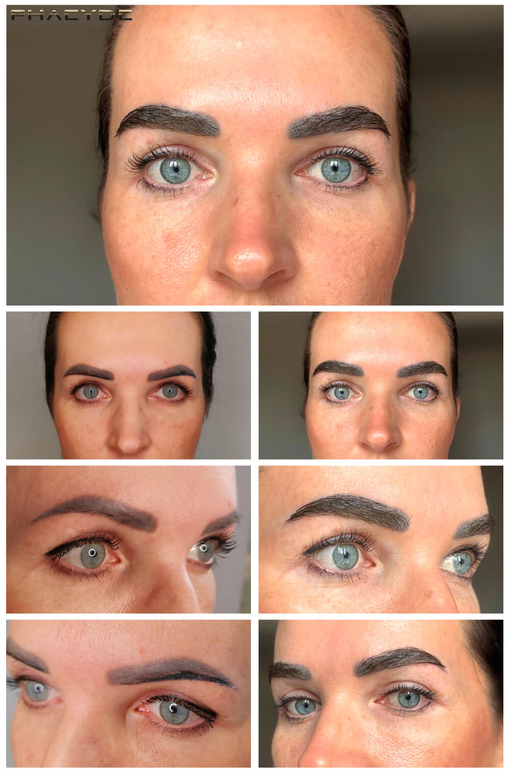 Øyenbryn Transplantasjon